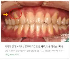 교정하고 잇몸이 내려갔어요 / 잇몸 퇴축 치아 손상없이 무삭제 라미네이트로 치료 > 원장님 칼럼 | 강남레옹치과